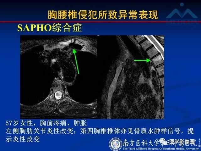 【PPT】系统性疾病脊椎侵犯病理学改变和影像学诊断