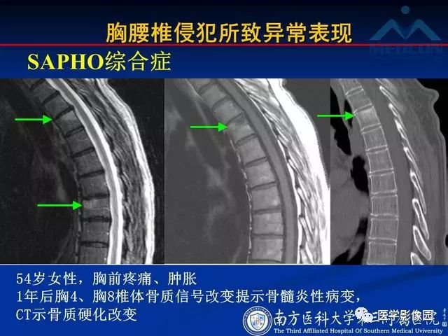 【PPT】系统性疾病脊椎侵犯病理学改变和影像学诊断