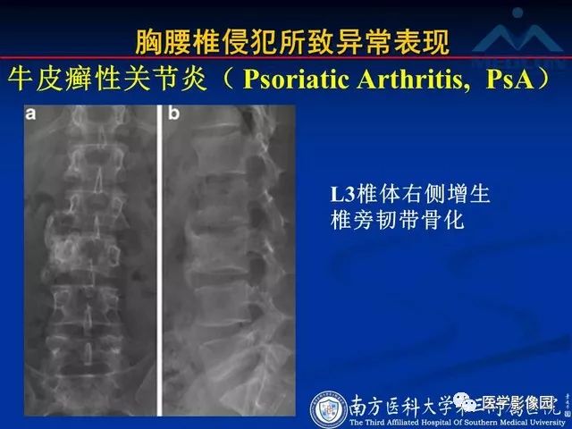 【PPT】系统性疾病脊椎侵犯病理学改变和影像学诊断