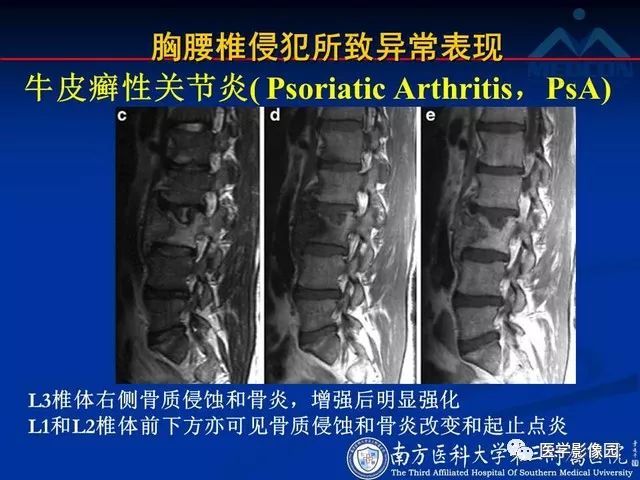 【PPT】系统性疾病脊椎侵犯病理学改变和影像学诊断