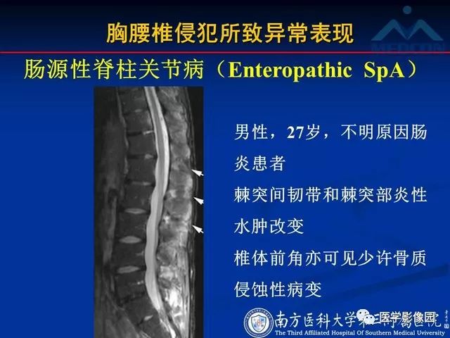【PPT】系统性疾病脊椎侵犯病理学改变和影像学诊断