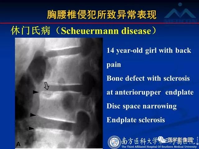 【PPT】系统性疾病脊椎侵犯病理学改变和影像学诊断