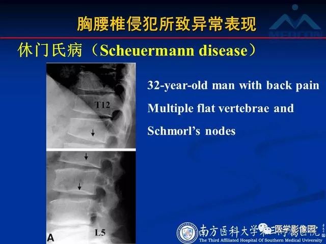 【PPT】系统性疾病脊椎侵犯病理学改变和影像学诊断