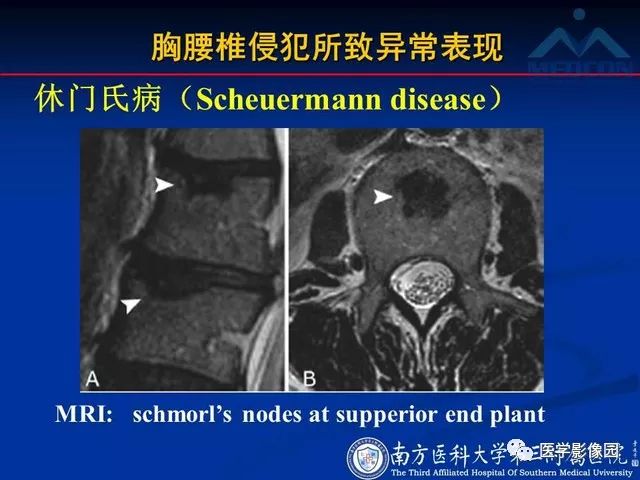 【PPT】系统性疾病脊椎侵犯病理学改变和影像学诊断