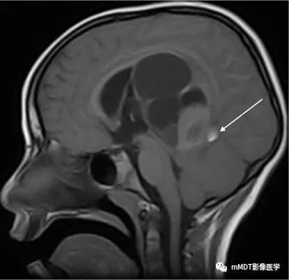 颅内常见T1WI高信号组织总结 颅内常见T1WI高信号组织总结