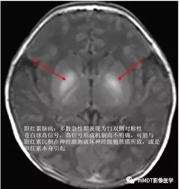颅内常见T1WI高信号组织总结 颅内常见T1WI高信号组织总结