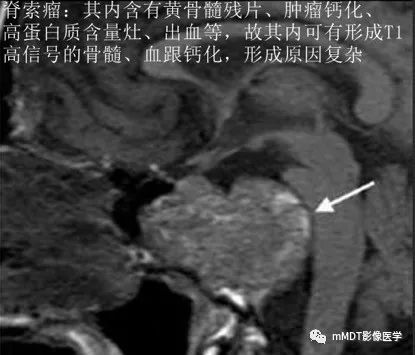 颅内常见T1WI高信号组织总结 颅内常见T1WI高信号组织总结