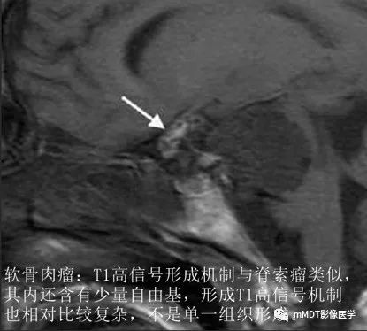 颅内常见T1WI高信号组织总结 颅内常见T1WI高信号组织总结