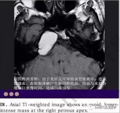 颅内常见T1WI高信号组织总结 颅内常见T1WI高信号组织总结