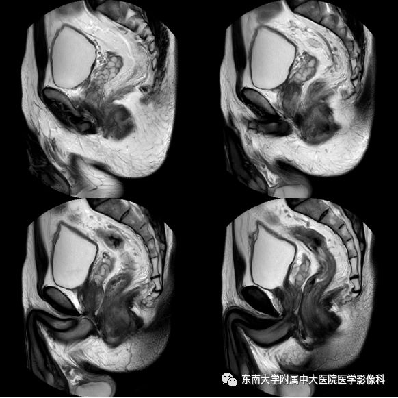【病例】肛瘘2例MR诊断及报告