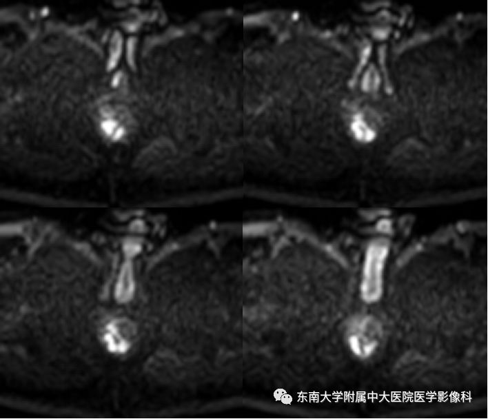 【病例】肛瘘2例MR诊断及报告