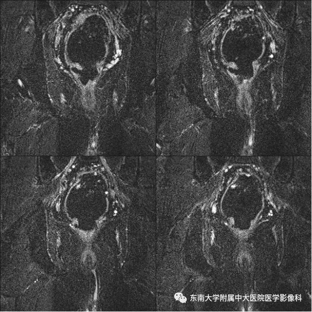 【病例】肛瘘2例MR诊断及报告