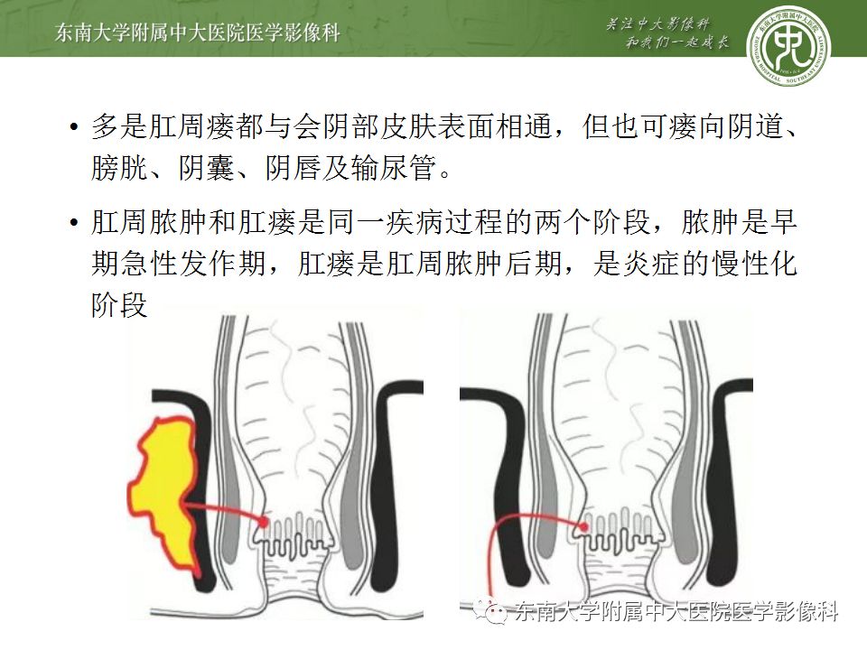 【病例】肛瘘2例MR诊断及报告