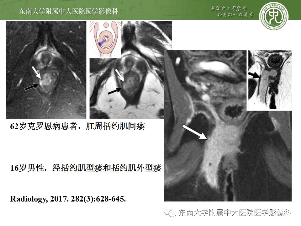【病例】肛瘘2例MR诊断及报告