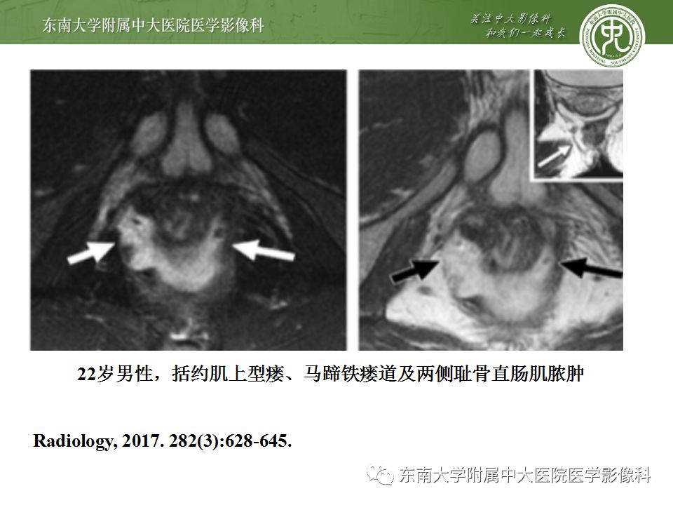 【病例】肛瘘2例MR诊断及报告