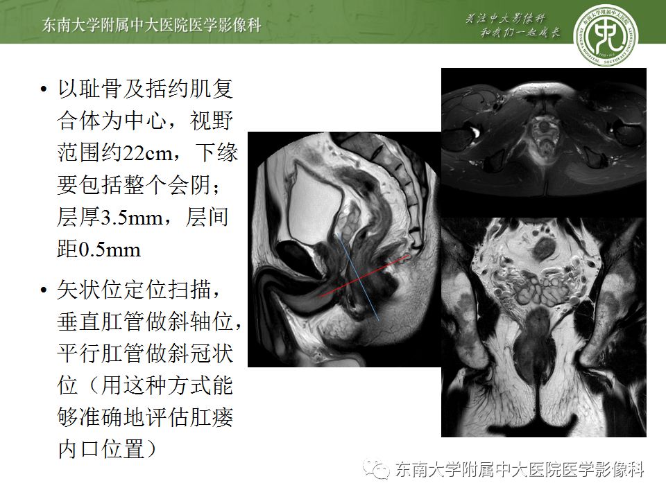 【病例】肛瘘2例MR诊断及报告