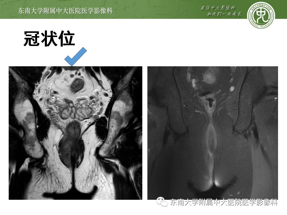 【病例】肛瘘2例MR诊断及报告