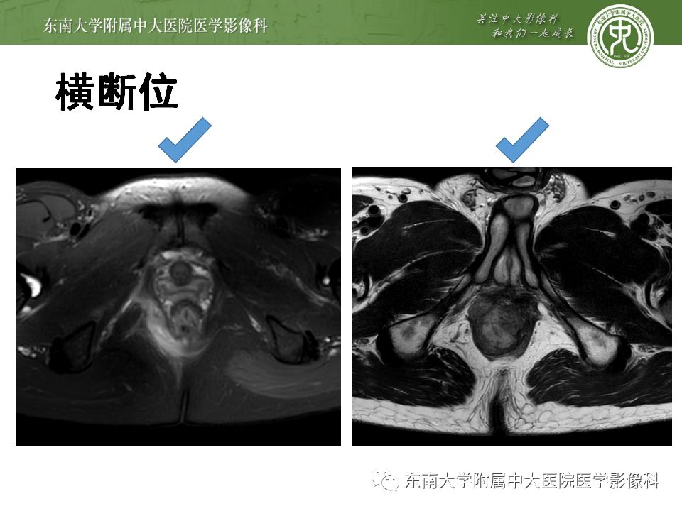 【病例】肛瘘2例MR诊断及报告