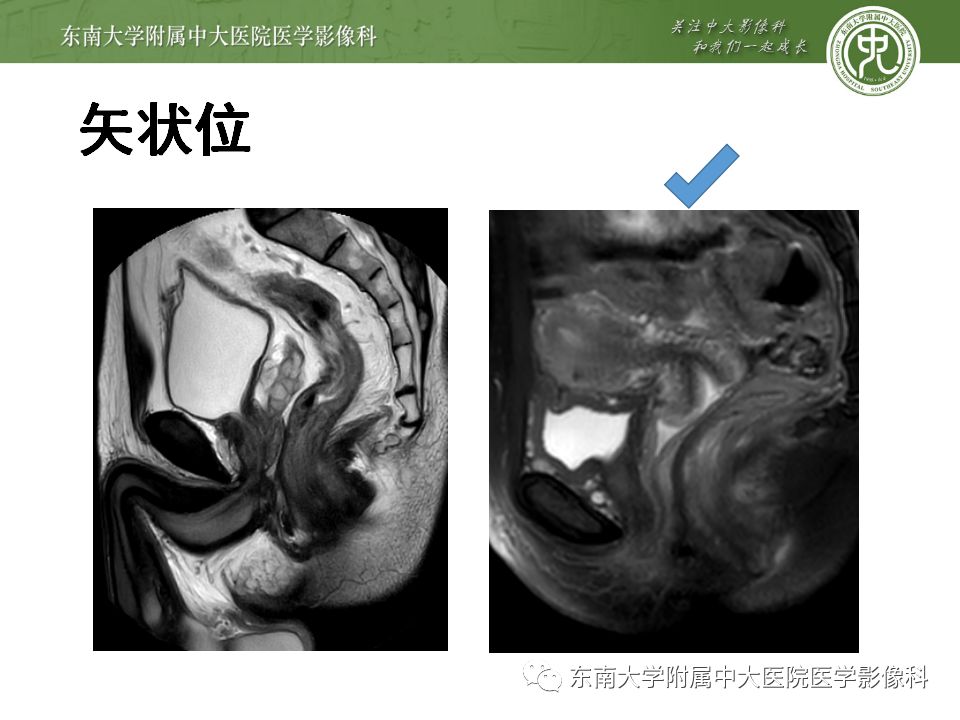【病例】肛瘘2例MR诊断及报告