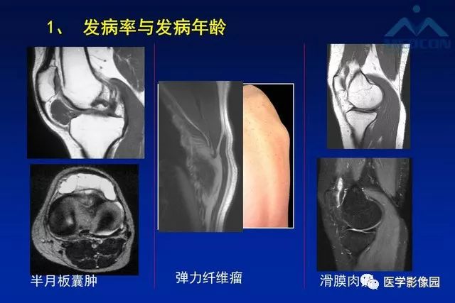 【PPT】软组织肿瘤鉴别诊断：MR作用