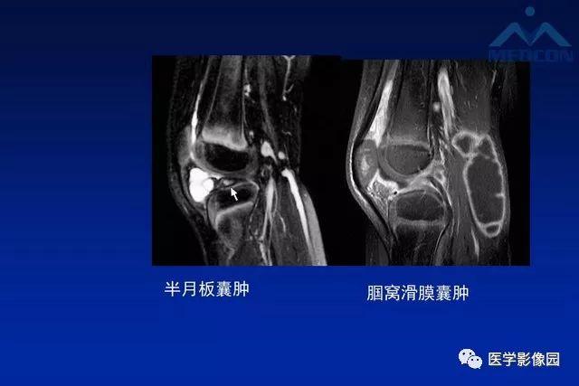 【PPT】软组织肿瘤鉴别诊断：MR作用