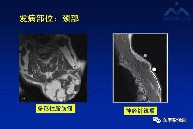 【PPT】软组织肿瘤鉴别诊断：MR作用