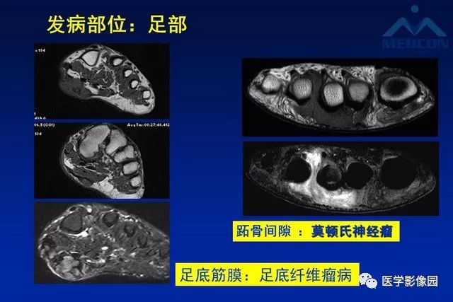 【PPT】软组织肿瘤鉴别诊断：MR作用
