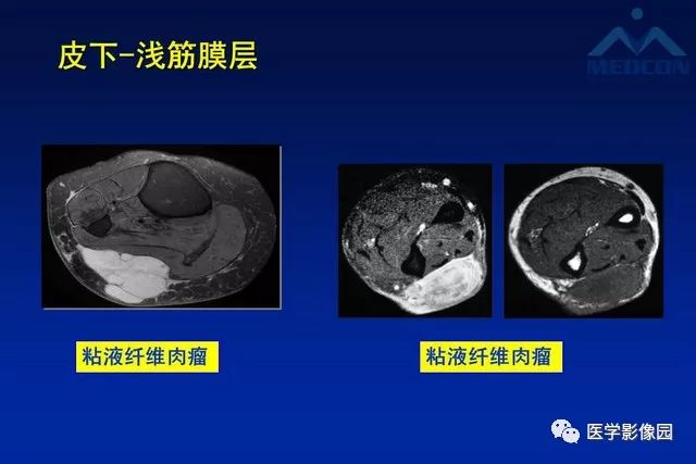 【PPT】软组织肿瘤鉴别诊断：MR作用