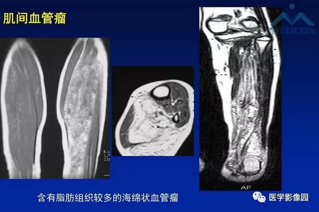 【PPT】软组织肿瘤鉴别诊断：MR作用