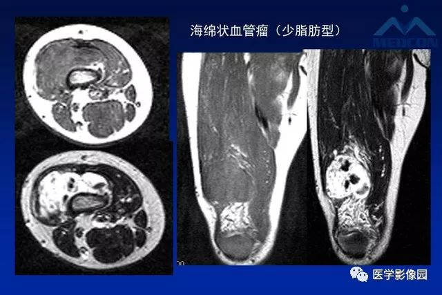 【PPT】软组织肿瘤鉴别诊断：MR作用