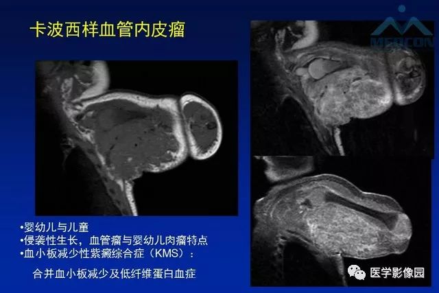 【PPT】软组织肿瘤鉴别诊断：MR作用