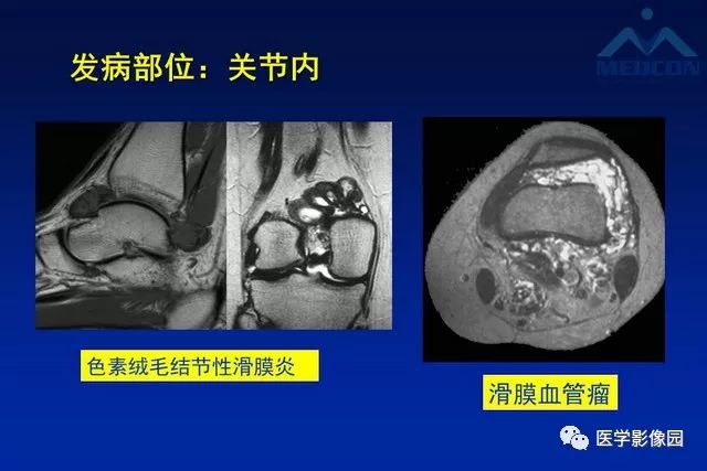 【PPT】软组织肿瘤鉴别诊断：MR作用