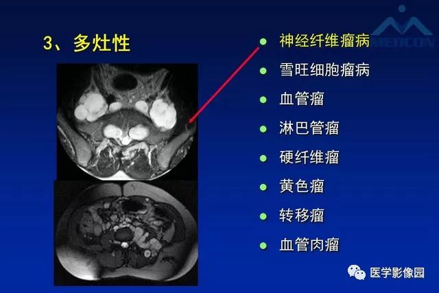 【PPT】软组织肿瘤鉴别诊断：MR作用
