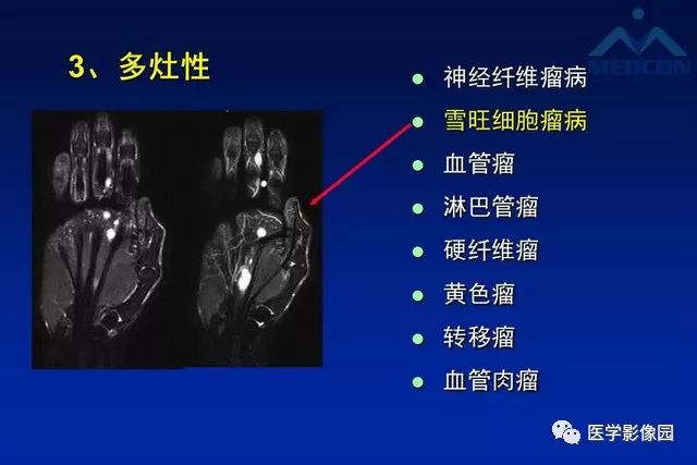 【PPT】软组织肿瘤鉴别诊断：MR作用