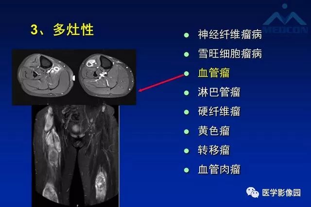 【PPT】软组织肿瘤鉴别诊断：MR作用