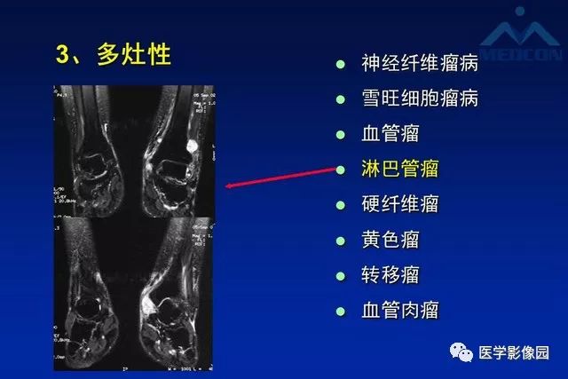 【PPT】软组织肿瘤鉴别诊断：MR作用