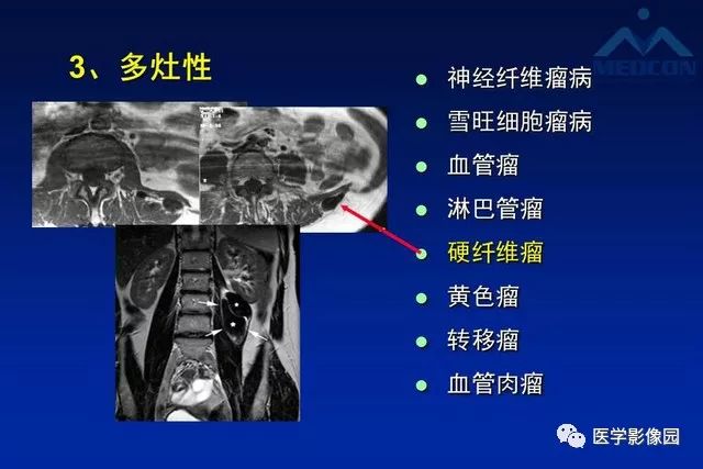 【PPT】软组织肿瘤鉴别诊断：MR作用