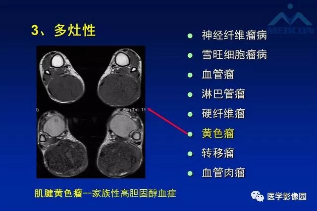 【PPT】软组织肿瘤鉴别诊断：MR作用