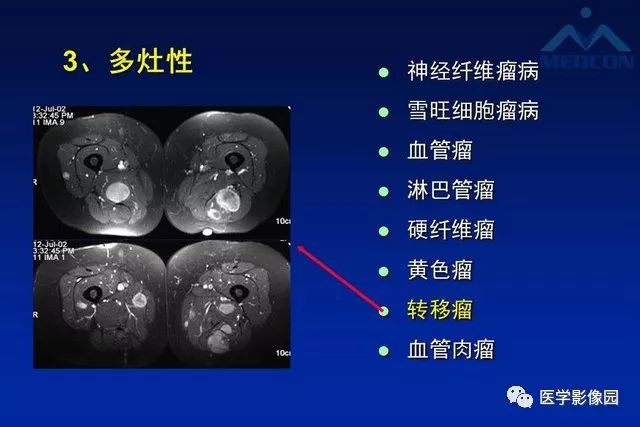 【PPT】软组织肿瘤鉴别诊断：MR作用