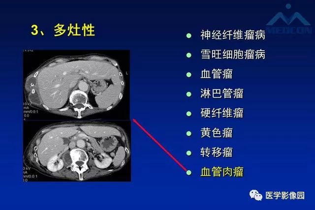 【PPT】软组织肿瘤鉴别诊断：MR作用