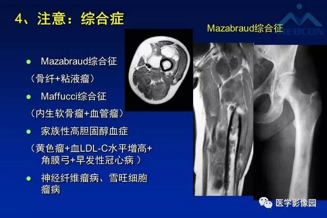 【PPT】软组织肿瘤鉴别诊断：MR作用