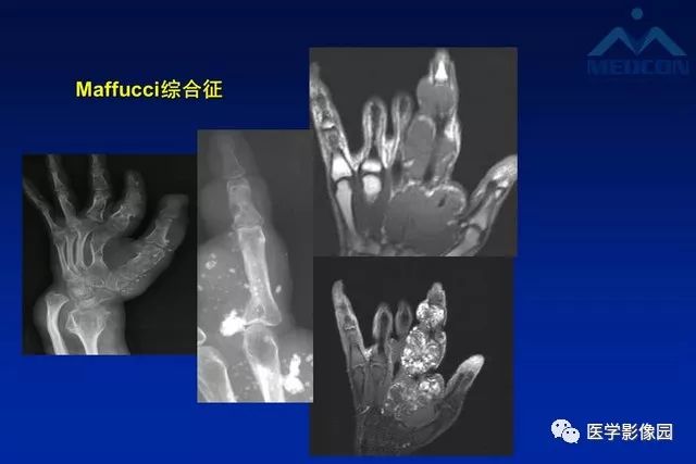 【PPT】软组织肿瘤鉴别诊断：MR作用