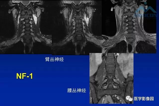 【PPT】软组织肿瘤鉴别诊断：MR作用
