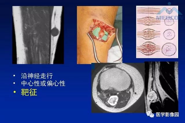 【PPT】软组织肿瘤鉴别诊断：MR作用