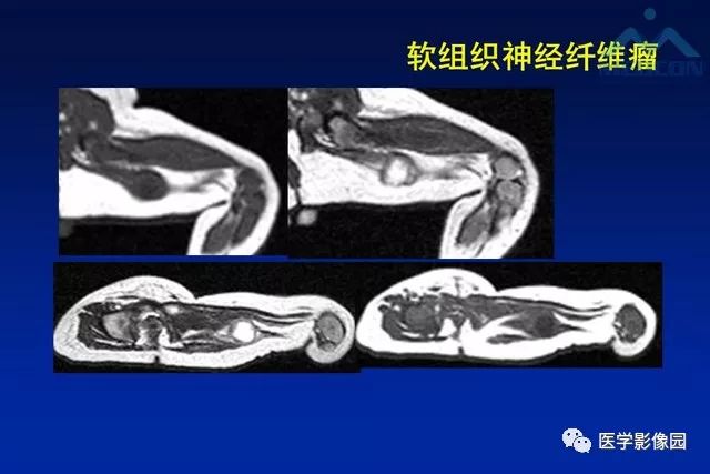 【PPT】软组织肿瘤鉴别诊断：MR作用