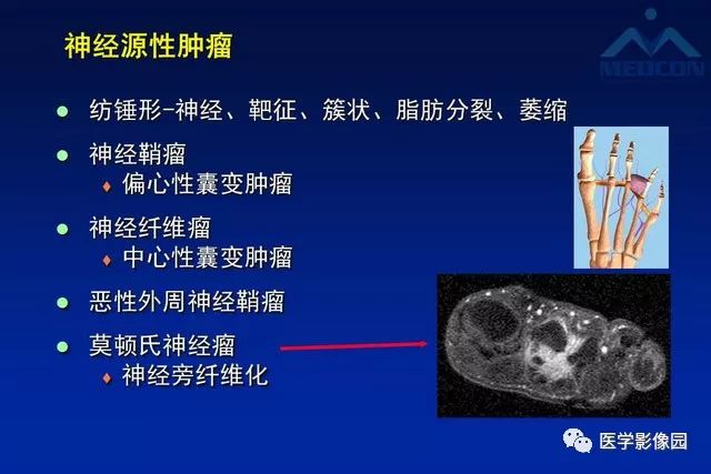 【PPT】软组织肿瘤鉴别诊断：MR作用