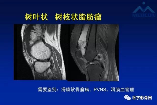 【PPT】软组织肿瘤鉴别诊断：MR作用
