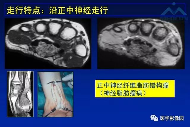 【PPT】软组织肿瘤鉴别诊断：MR作用