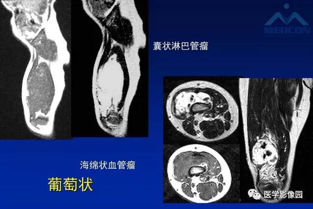 【PPT】软组织肿瘤鉴别诊断：MR作用