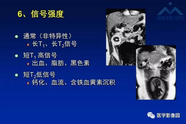 【PPT】软组织肿瘤鉴别诊断：MR作用
